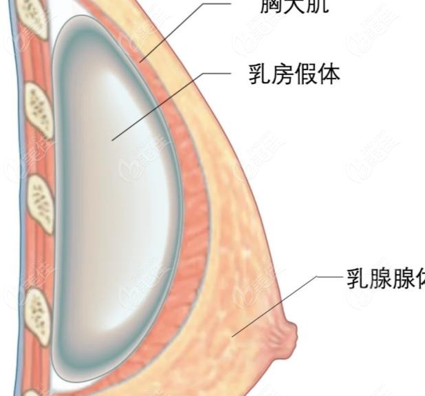 夢(mèng)縈假體優(yōu)勢(shì)二：比普通假體變軟快