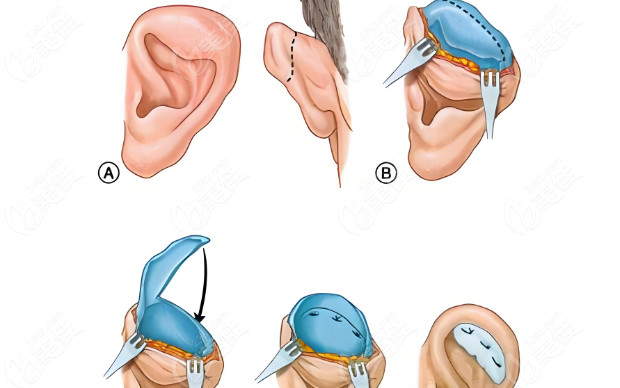 耳整形再造手术www.236z.com