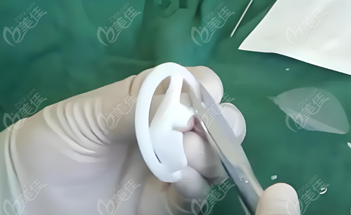 耳再造手术www.236z.com 耳再造手术www.236z.com