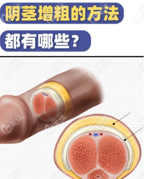 生殖器整形手术www.236z.com
