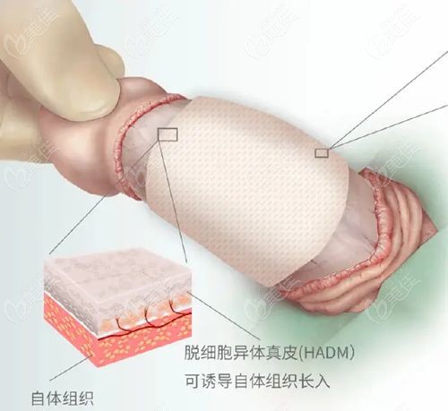 男性生物补片增粗可以维持几年