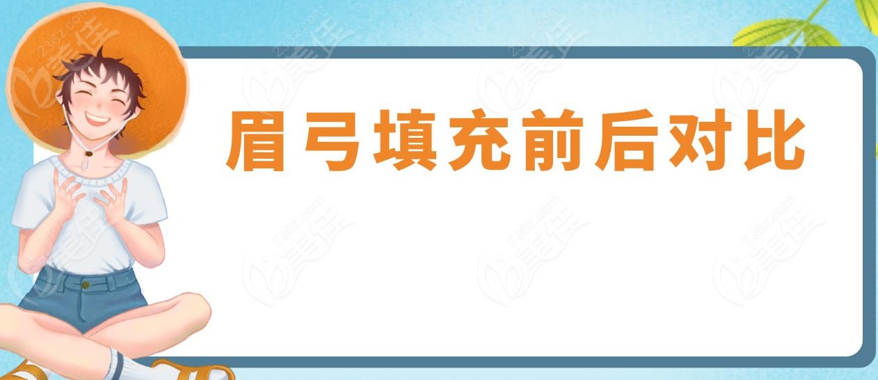 眉弓填充前后对比