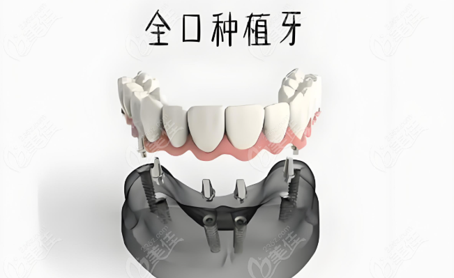 满口假牙