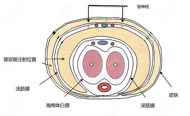 打玻尿酸增粗