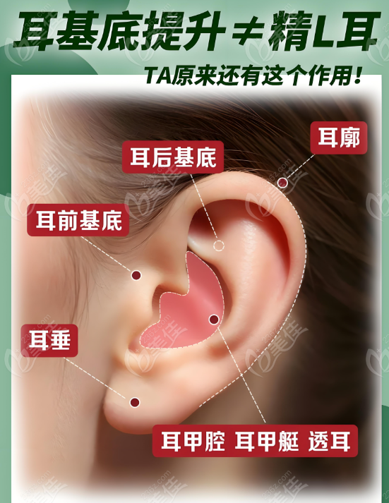 注射耳基底提升不是精靈耳