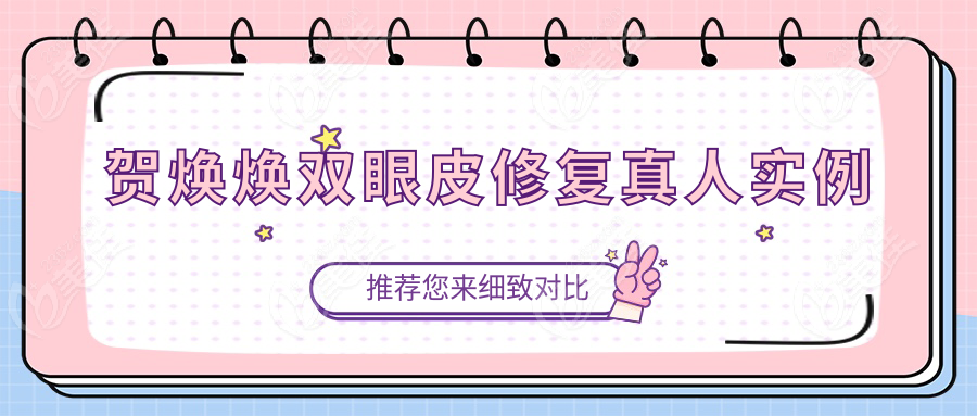 贺焕焕双眼皮修复真人实例