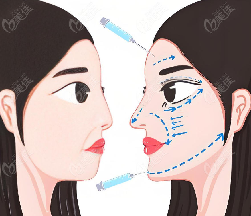 李俊霞面部輪廓注射