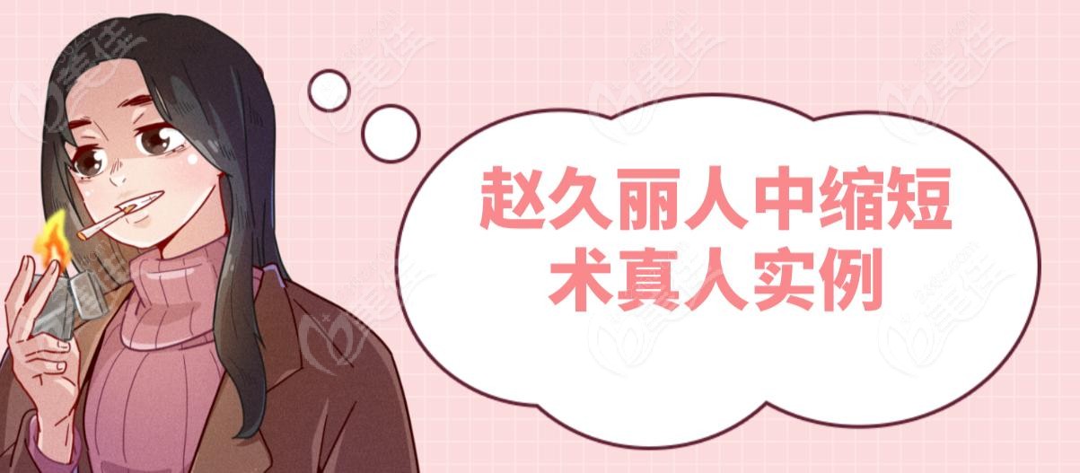 赵久丽人中缩短术真人实例