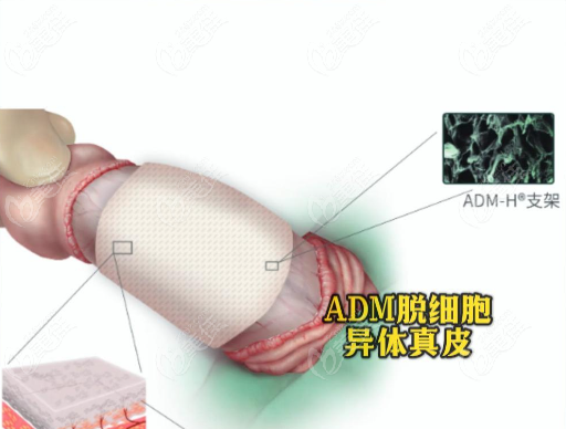 做生物补片增粗价格表