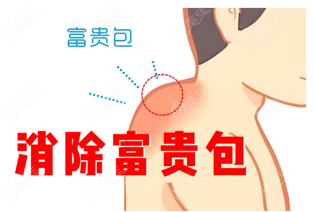 消除富贵包