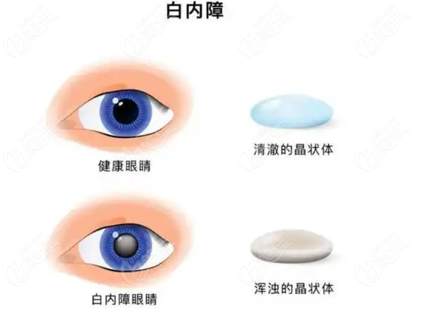 白內(nèi)障m.pfflawyer.com