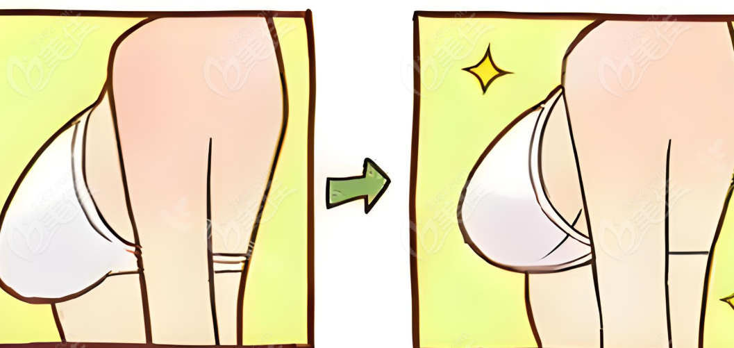 胸部手术