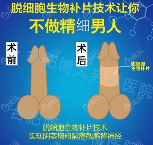 李世荣生物补片增粗实例介绍