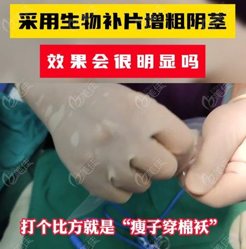 李世荣生物补片增粗费用5万起