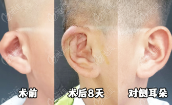 吳建明耳畸形