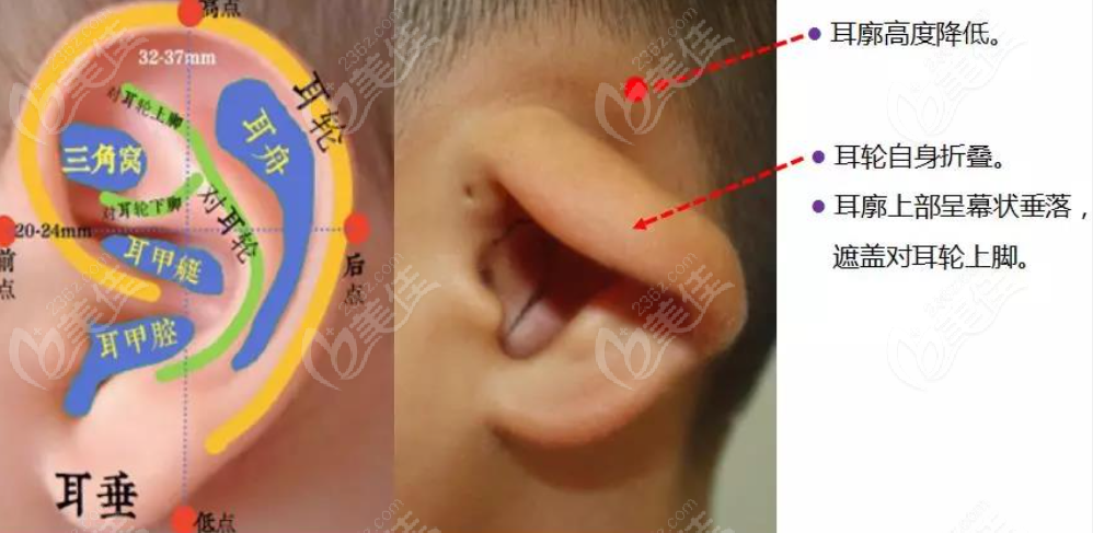 吳建明耳畸形