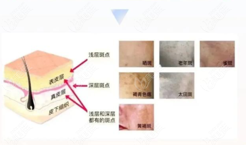 光子嫩肤