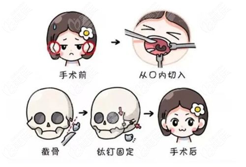 罗恩磨骨在华西贵