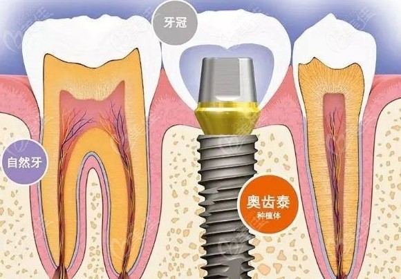 口腔种植
