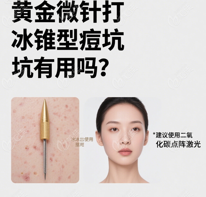 黃金微針打冰錐型痘坑有用嗎