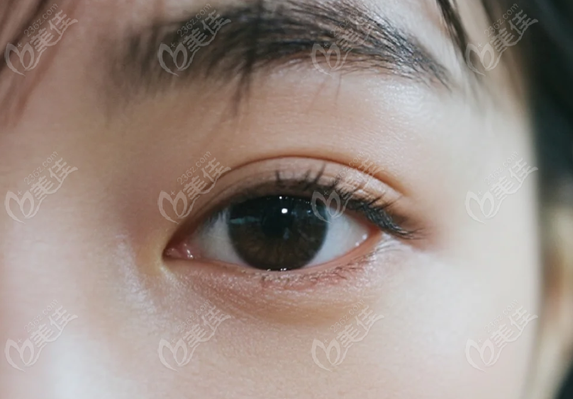 華祖廣割雙眼皮手術(shù)怎么樣？?jī)?yōu)勢(shì)