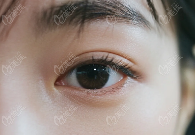 北京美萊上瞼下垂矯正術(shù)后：悉心護(hù)理，見(jiàn)證美麗改變