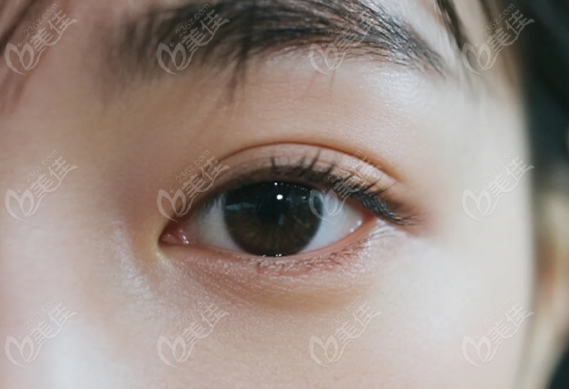 重庆华美双眼皮好的医生是谁？李富强、谷琪、陈凯技术对比