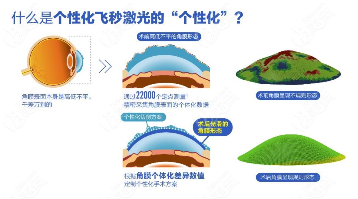 个性化飞秒手术