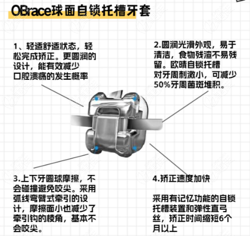 歐晴自鎖托槽