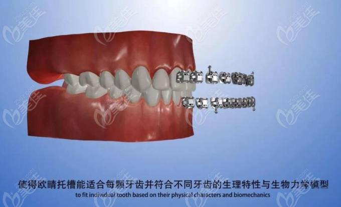 歐晴自鎖托槽