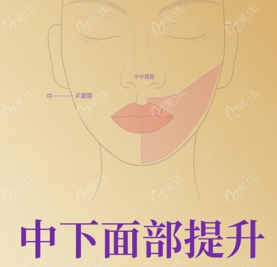 黄寅守做面部提升怎么样