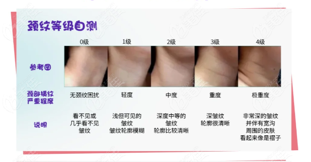 谁适合冲格格针去颈纹