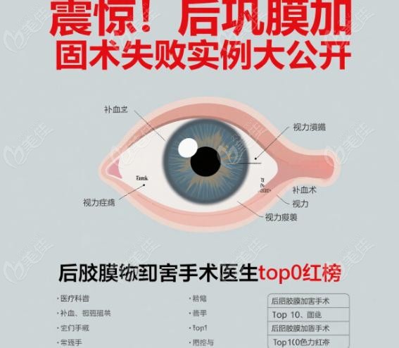后巩膜加固术失败实例自述