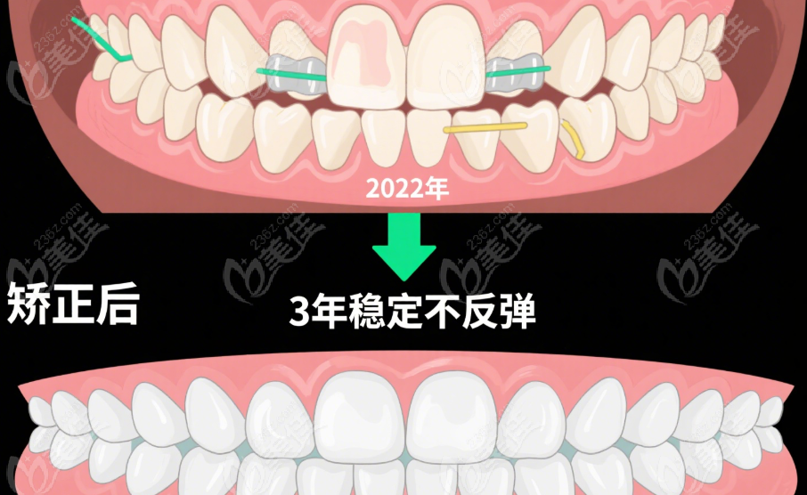 正畸前后對比