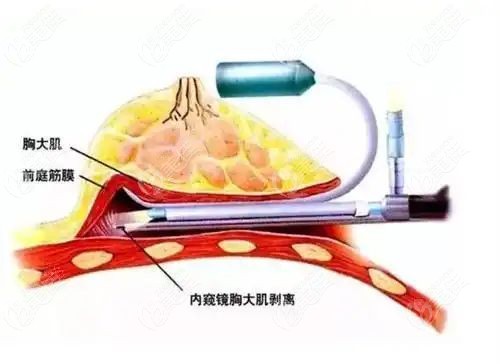 沈正宇医生擅长丰胸手术