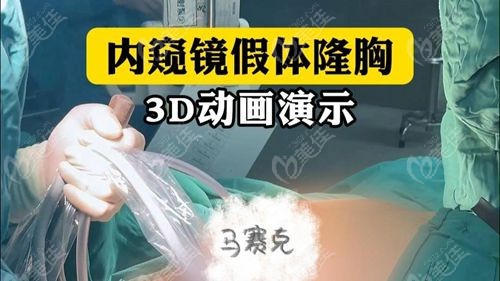 沈正宇擅长内窥镜假体丰胸 + 隆胸修复手术