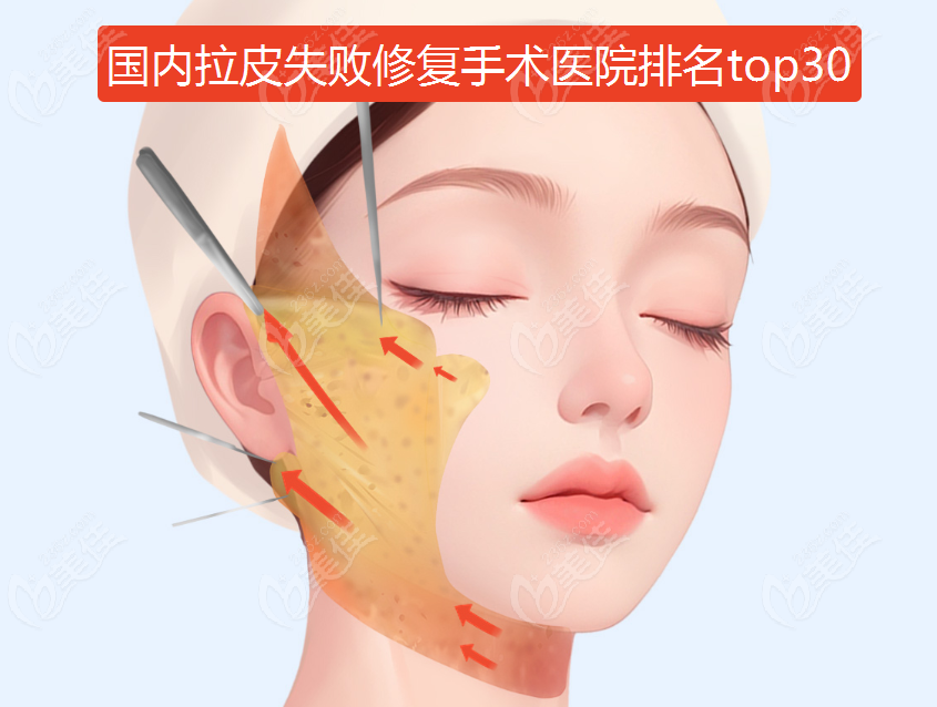 国内拉皮失败修复手术医院排名top30