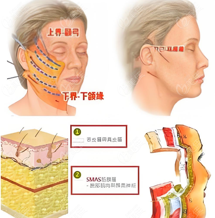 拉皮手术
