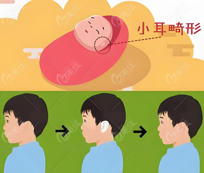 为什么选择章庆国医生做耳再造？www.236z.com