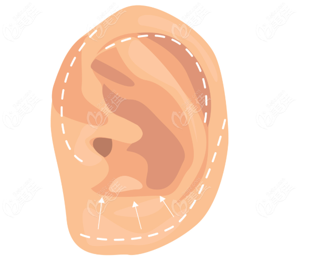 耳畸形矯正手術(shù)www.pfflawyer.com 耳畸形矯正手術(shù)www.pfflawyer.com