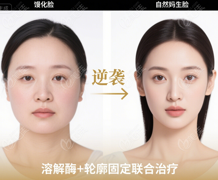 玻尿酸填成发面馒头脸？实测过度填充馒化脸修复溶解酶+轮廓固定逆袭自然妈生脸