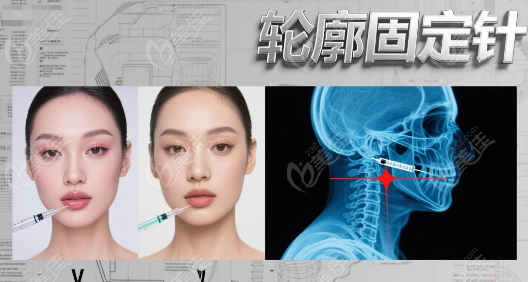 网红推荐轮廓固定针打针幼态脸好
