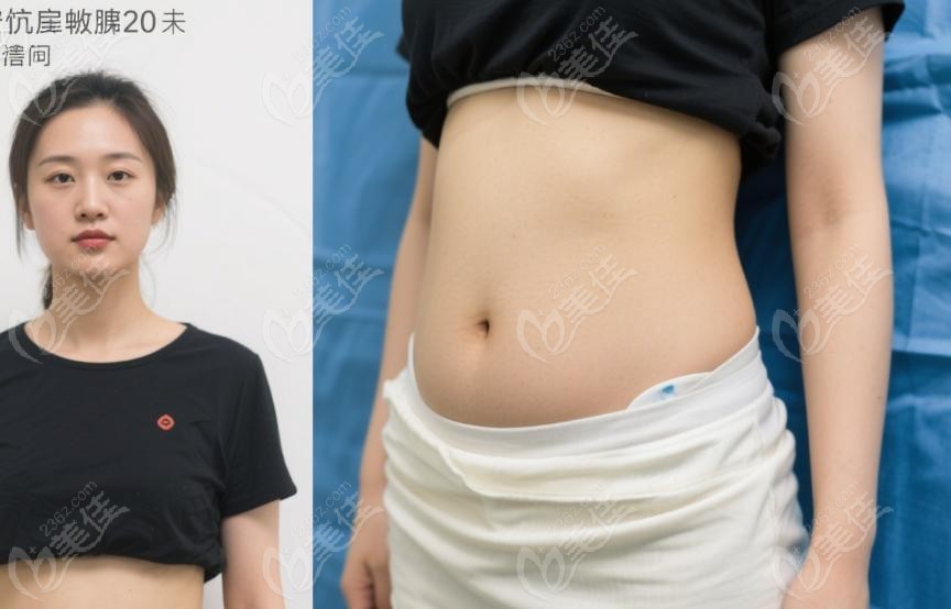 冯斌吸脂20天了还是瘦的腻害正常吗