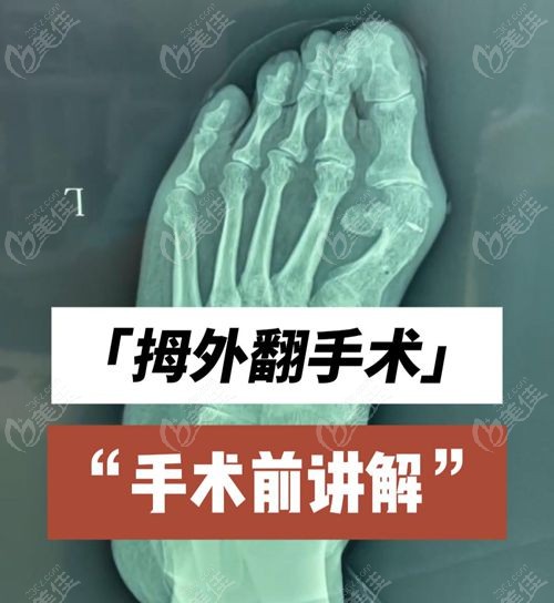 北京协和医院整形科拇外翻大夫