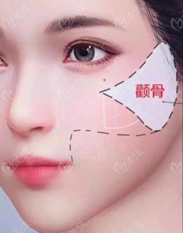 八大处颧骨内推预约挂号指南