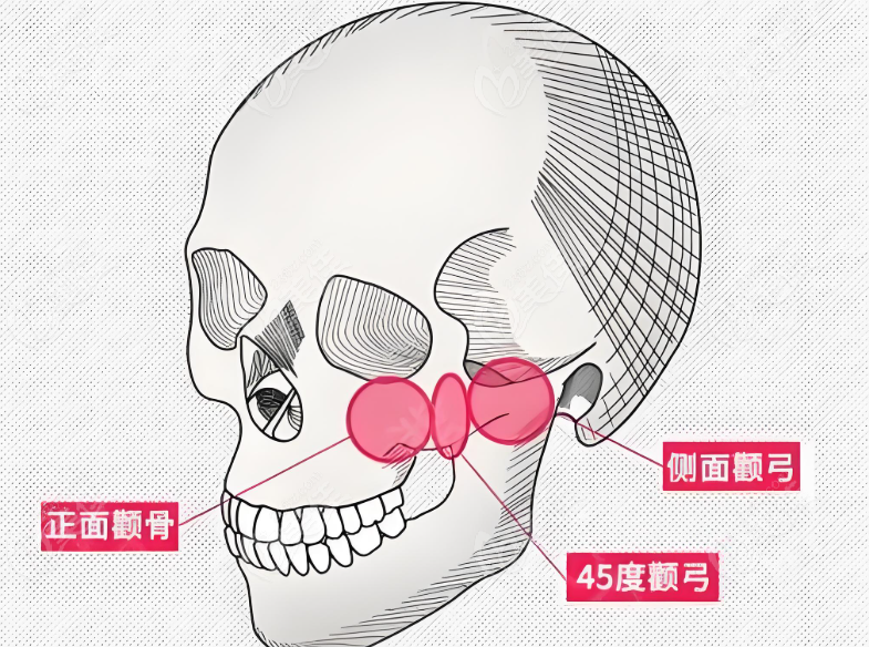 颧骨内推手术