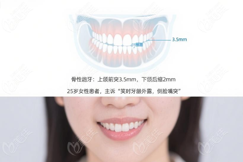 刘思琦医生解决骨性龅牙的临界方案核心技术