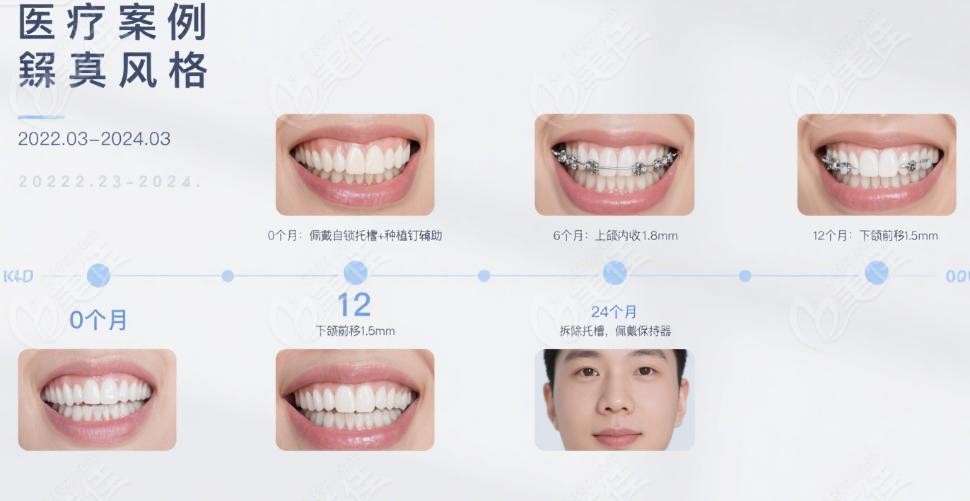 为什么成人骨性矫正更需认准刘思琦医生