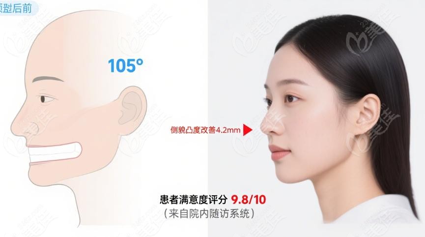 骨性龅牙矫正常见疑问深度解答