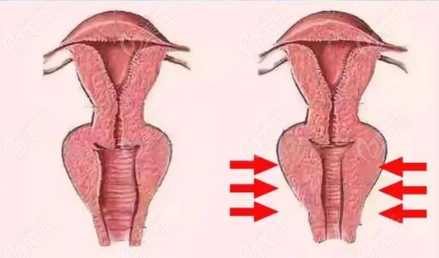 做私密緊致手術(shù)